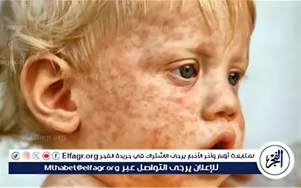 متحدث الصحة: حملة التطعيم ضد الحصبة تستهدف 21 مليون طفل على مستوى الجمهورية