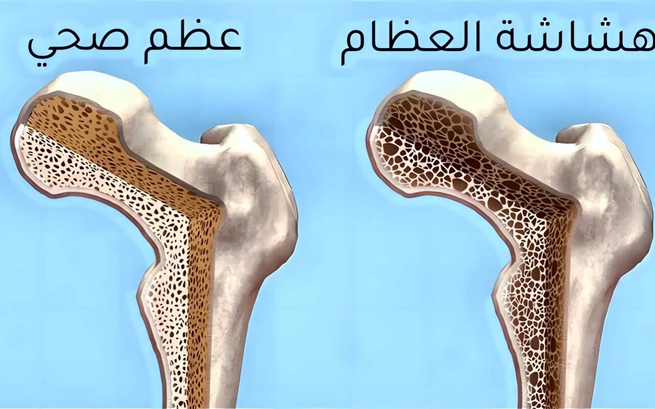 هشاشة العظام عند النساء، الأسباب والأعراض المبكرة وأفضل نظام غذائي للحفاظ على قوة العظام