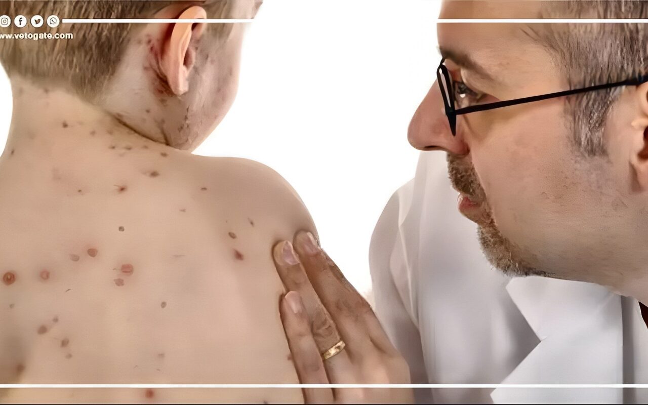 تبدأ كأنها نزلة برد، كيف تكتشف أعراض الحصبة؟