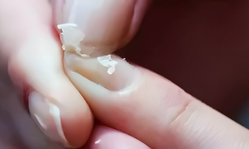 أعراض تكشف وجود نقص بالكالسيوم.. استشاري يوضح