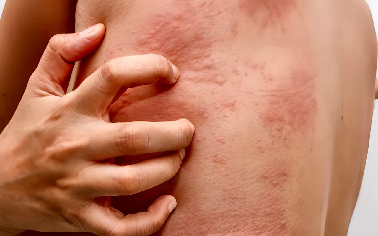 حساسية الألبان.. الأعراض والأسباب وطرق التشخيص والعلاج