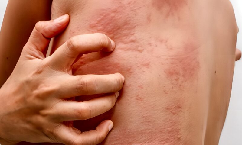 حساسية الألبان.. الأعراض والأسباب وطرق التشخيص والعلاج