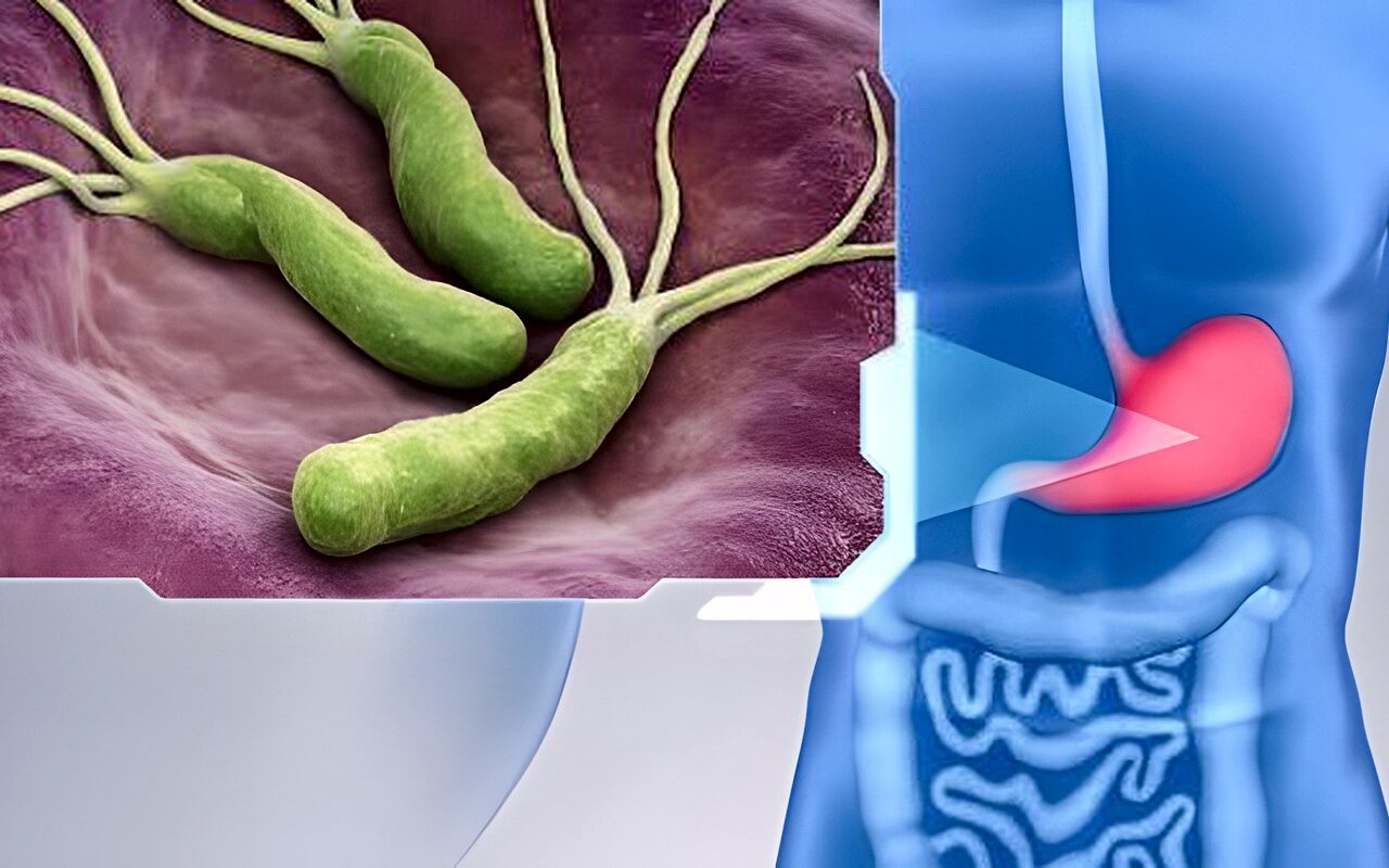 الكركم والثوم الأبرز.. 7 مكونات للتخلص من جرثومة المعدة طبيعيا