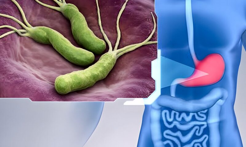 الكركم والثوم الأبرز.. 7 مكونات للتخلص من جرثومة المعدة طبيعيا