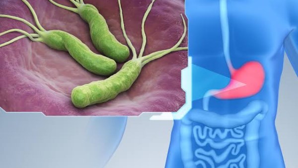 الكركم والثوم الأبرز.. 7 مكونات للتخلص من جرثومة المعدة طبيعيا