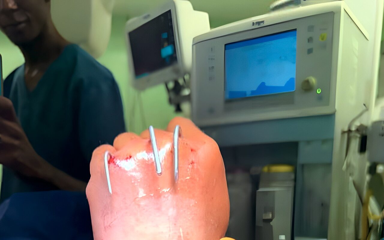 بعد 6 ساعات .. فريق جراحة التجميل بمستشفيات جامعة أسوان ينجح في إعادة «يد مبتورة»