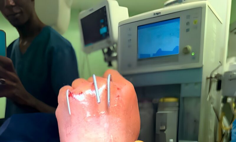 بعد 6 ساعات .. فريق جراحة التجميل بمستشفيات جامعة أسوان ينجح في إعادة «يد مبتورة»