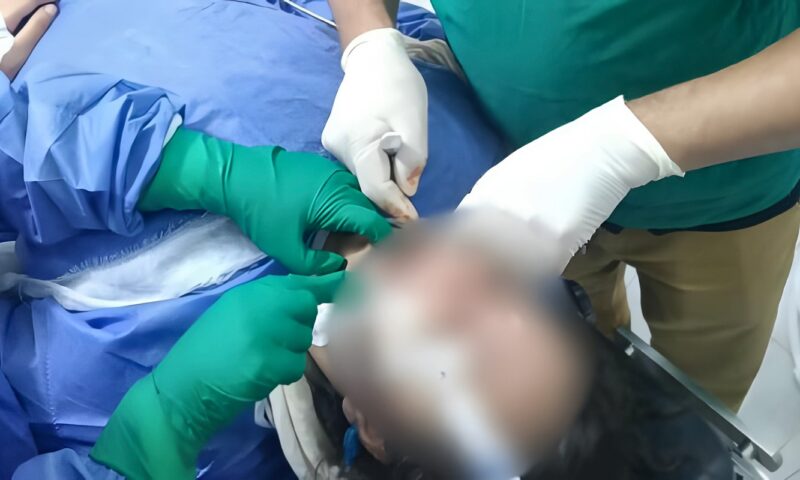 صحة الشرقية: إجراء عملية وجه وفكين دقيقة بمستشفى مشتول السوق المركزي لفتاة من ذوي الهمم