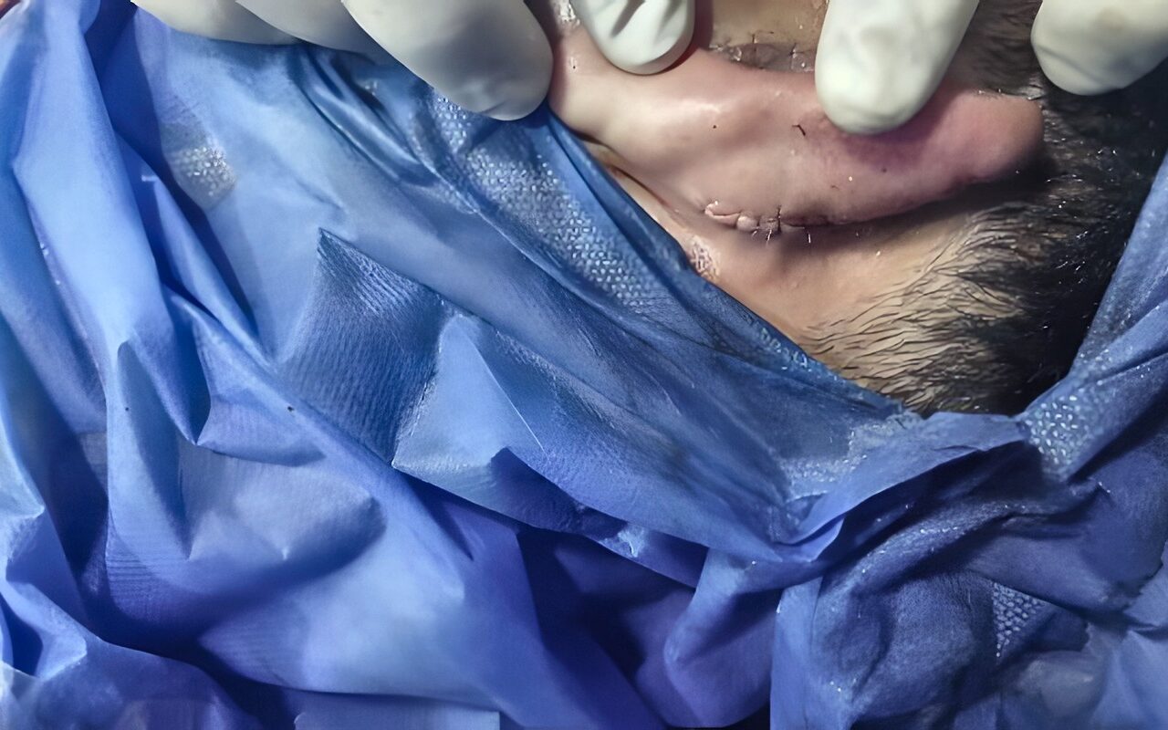بعد قطع أذنه..مستشفى بلبيس بالشرقية تنجح في إعادة زرع وترميم أذن شاب تعرض لحادث سير