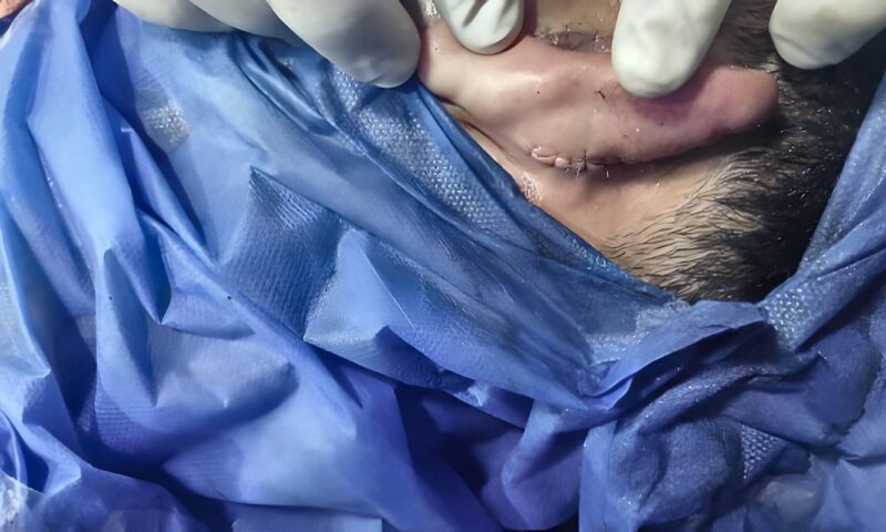 بعد قطع أذنه..مستشفى بلبيس بالشرقية تنجح في إعادة زرع وترميم أذن شاب تعرض لحادث سير