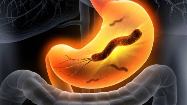 أعراض جرثومة المعدة المتقدمة.. وطرق علاجها نهائيا