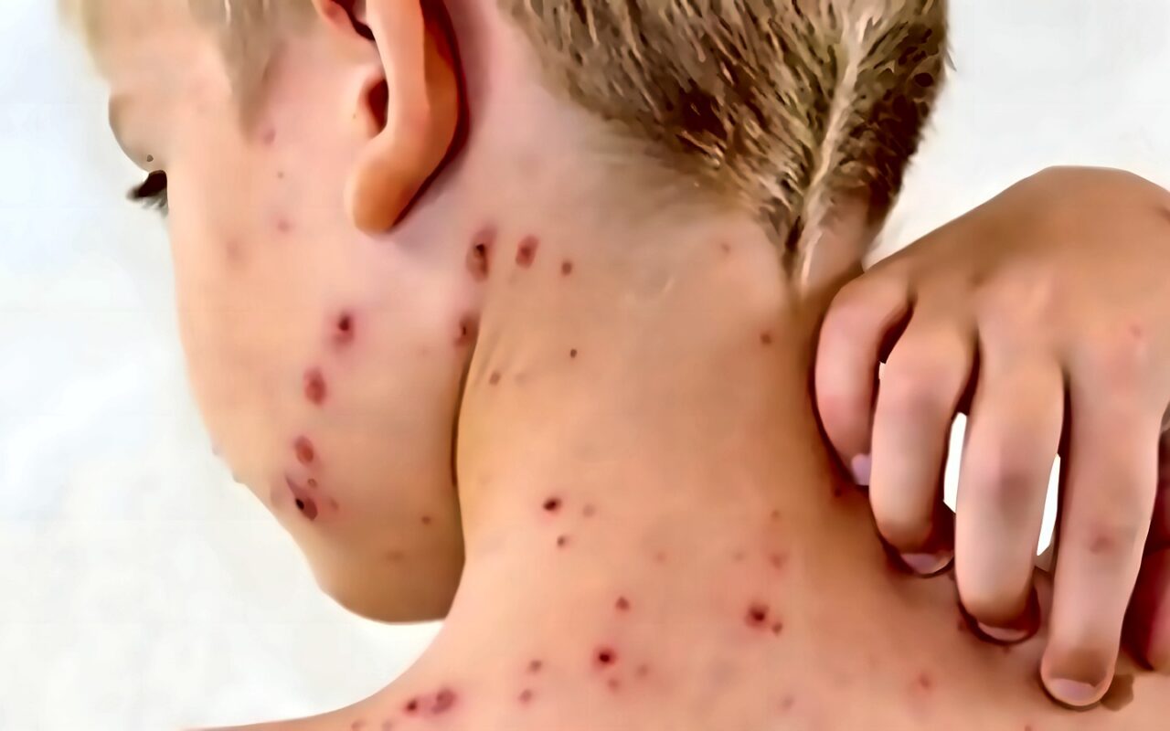 من 9 أشهر حتى 10 سنوات.. موعد انطلاق الحملة القومية للتطعيم ضد الحصبة