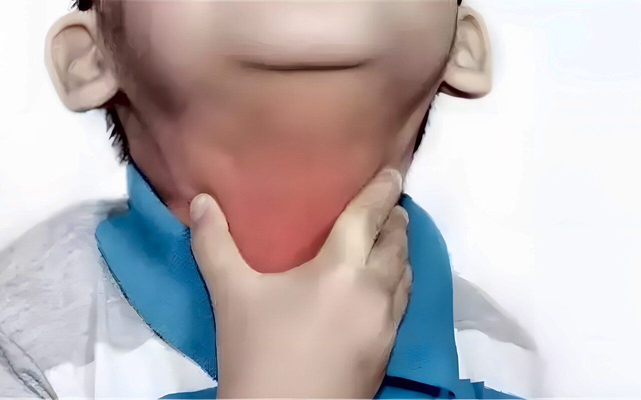 الخناق الحنجري عند الأطفال.. الأعراض وطرق الوقاية.. الصحة تطمئن أولياء الأمور: مرض موسمي معروف منذ عقود ولا تفشيات غير معتادة.. وتحذر من المضادات الحيوية دون استشارة الطبيب