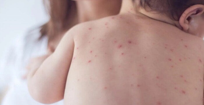 الحملة القومية للتطعيم ضد الحصبة تنطلق رسميًا.. الأماكن والمواعيد بالتفصيل